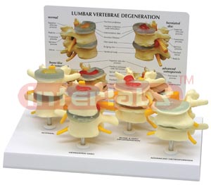 4-Stage Vertebrae